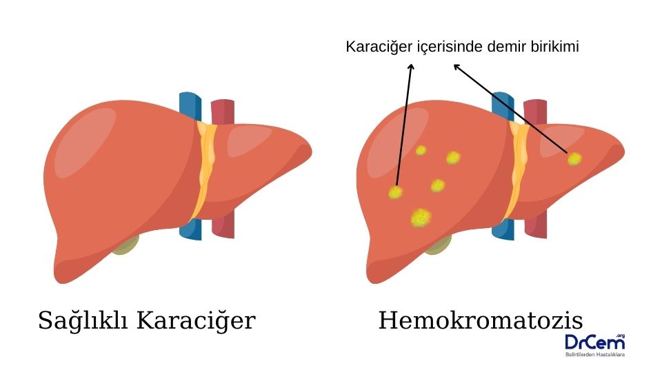Hemokromatozis görseli - DrCem hastalık rehberi