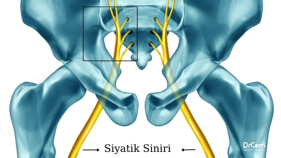 Siyatik görseli - DrCem hastalık rehberi