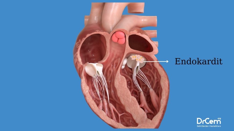 Endokardit görseli - DrCem hastalık rehberi