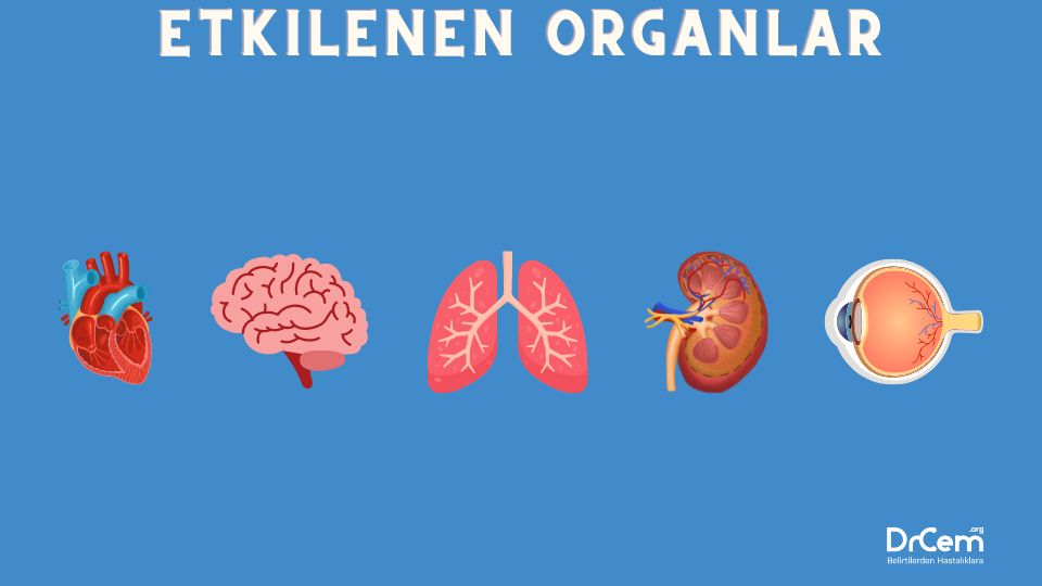 Tüberoskleroz görseli - DrCem hastalık rehberi