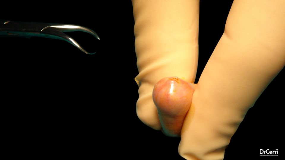 Fimozis görseli - DrCem hastalık rehberi