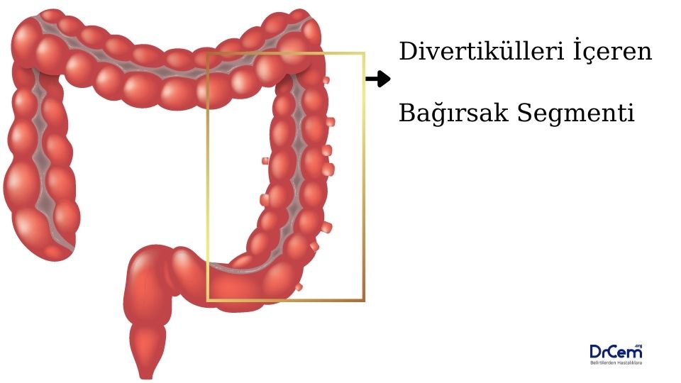 Divertikülit görseli - DrCem hastalık rehberi