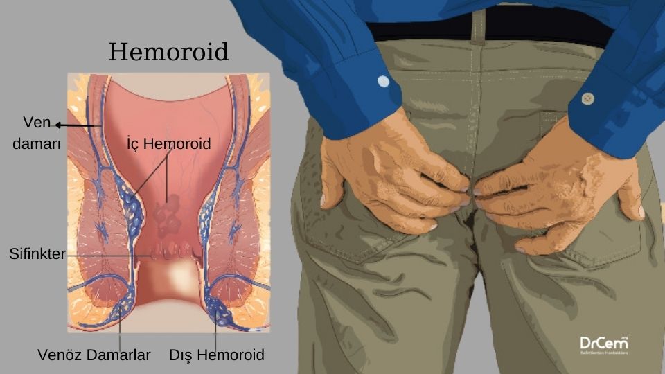 Hemoroid görseli - DrCem hastalık rehberi