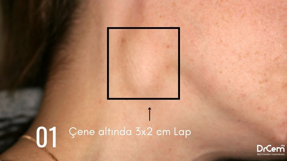 Lenfadenopati görseli - DrCem hastalık rehberi