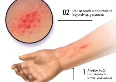 Alerji görseli - DrCem hastalık rehberi