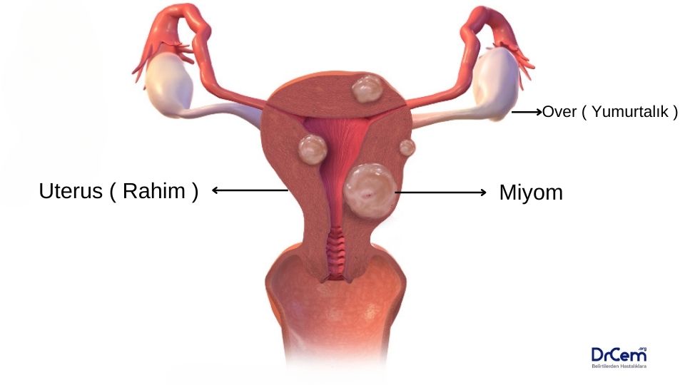 Myom görseli - DrCem hastalık rehberi