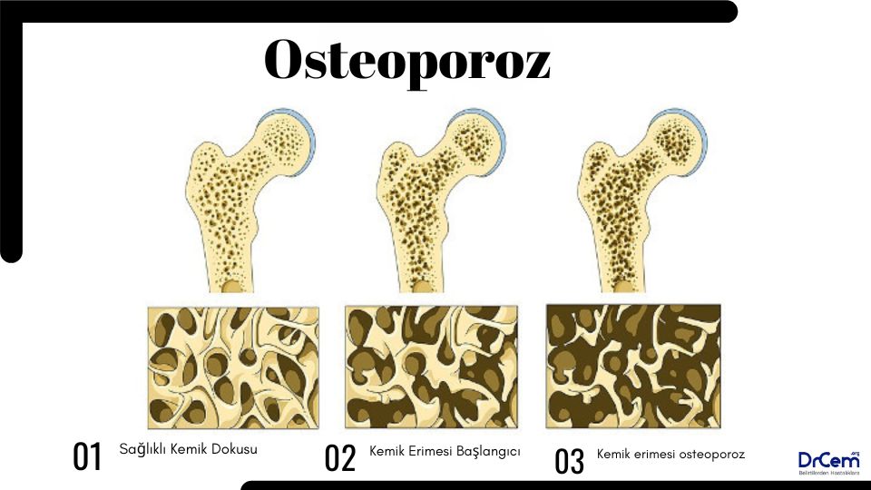 Osteoporoz görseli - DrCem hastalık rehberi