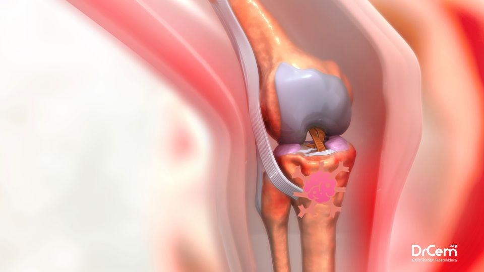 Osteosarkom görseli - DrCem hastalık rehberi