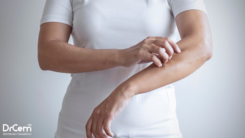 Sebebi Bilinmeyen Kaşıntı görseli - DrCem hastalık rehberi