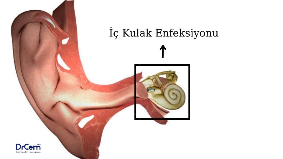 Labirentit görseli - DrCem hastalık rehberi