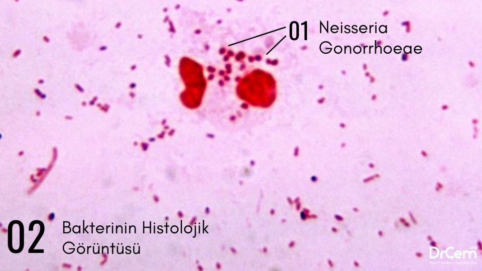 Gonore görseli - DrCem hastalık rehberi