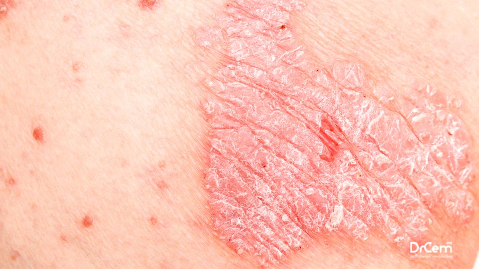 Psoriasis görseli - DrCem hastalık rehberi