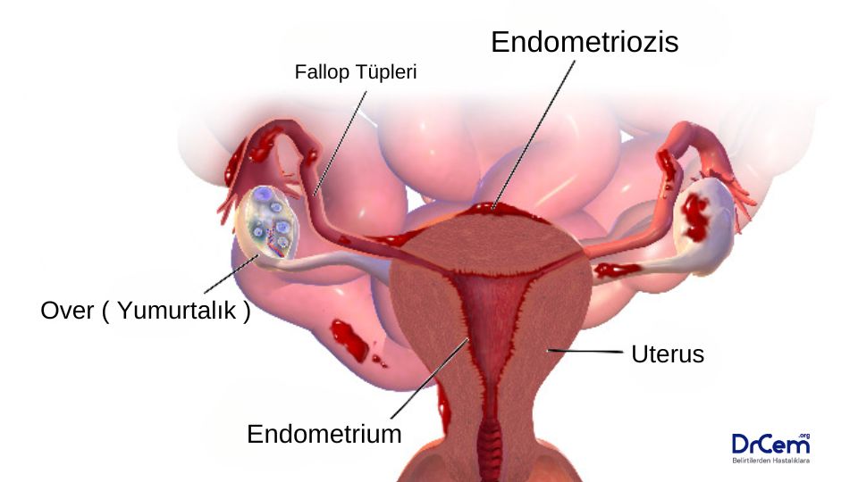 Endometriozis görseli - DrCem hastalık rehberi